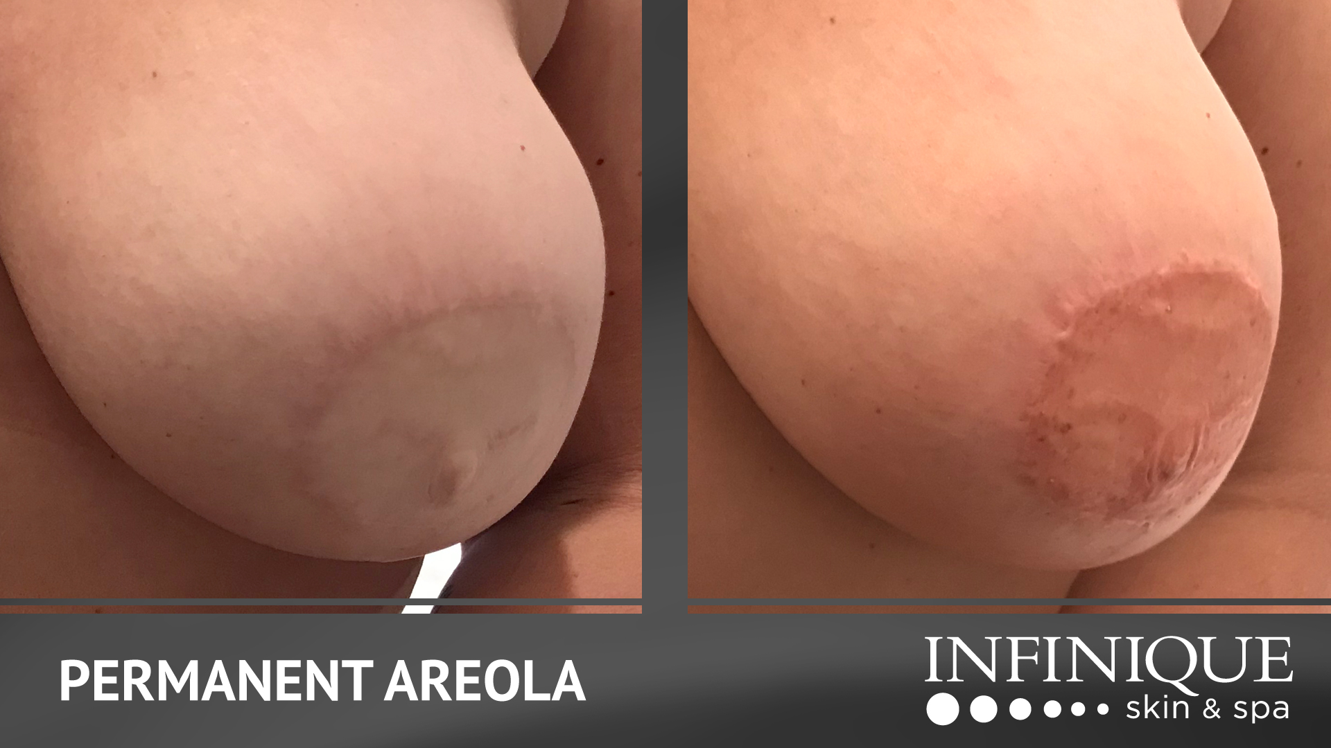 infinique-video-slides-areola-feb22-1