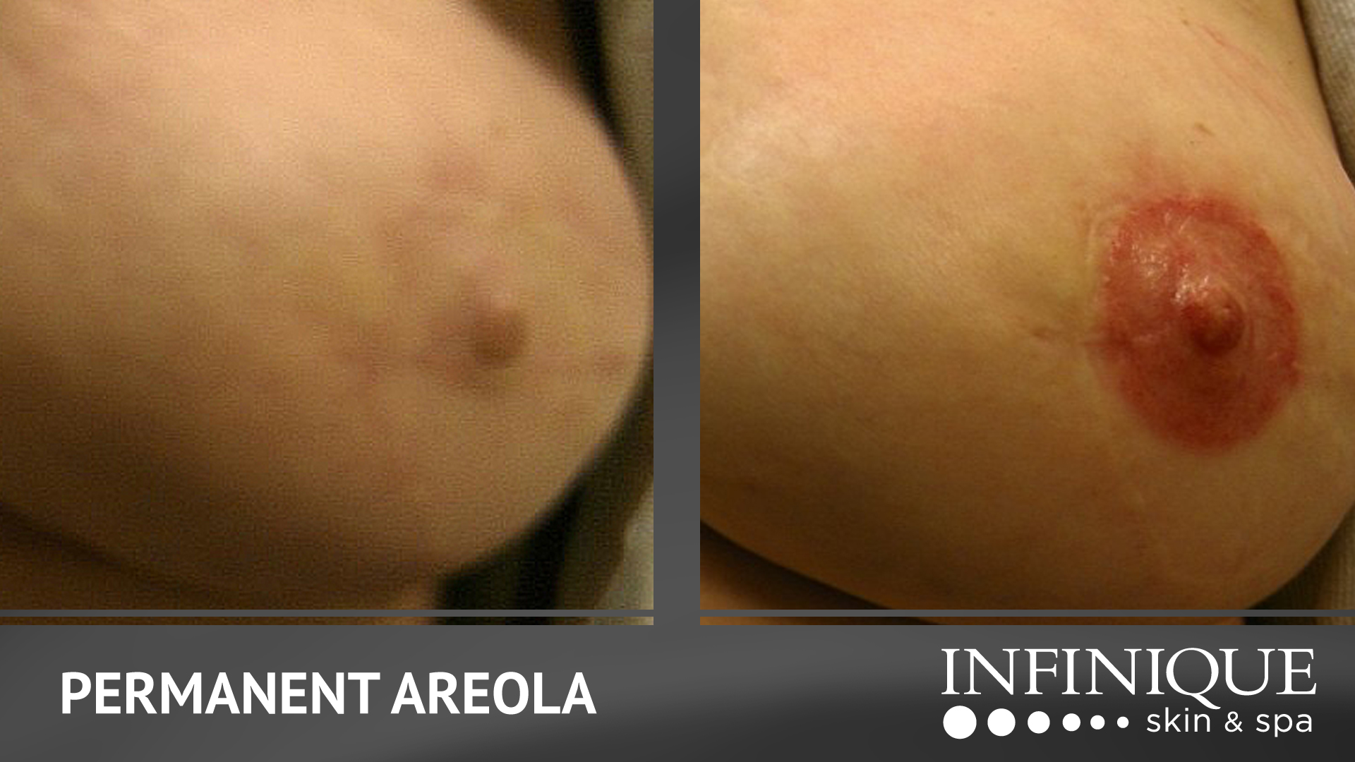 infinique-video-slides-areola-feb22-2