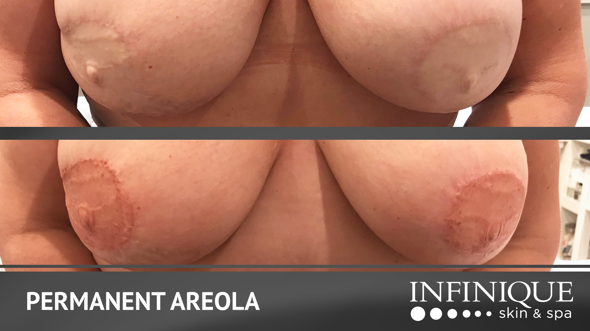 infinique-video-slides-areola-feb22-3
