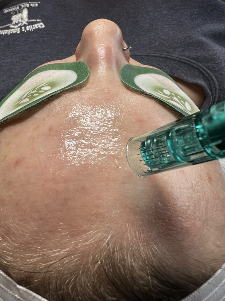 infinique-microneedling-10