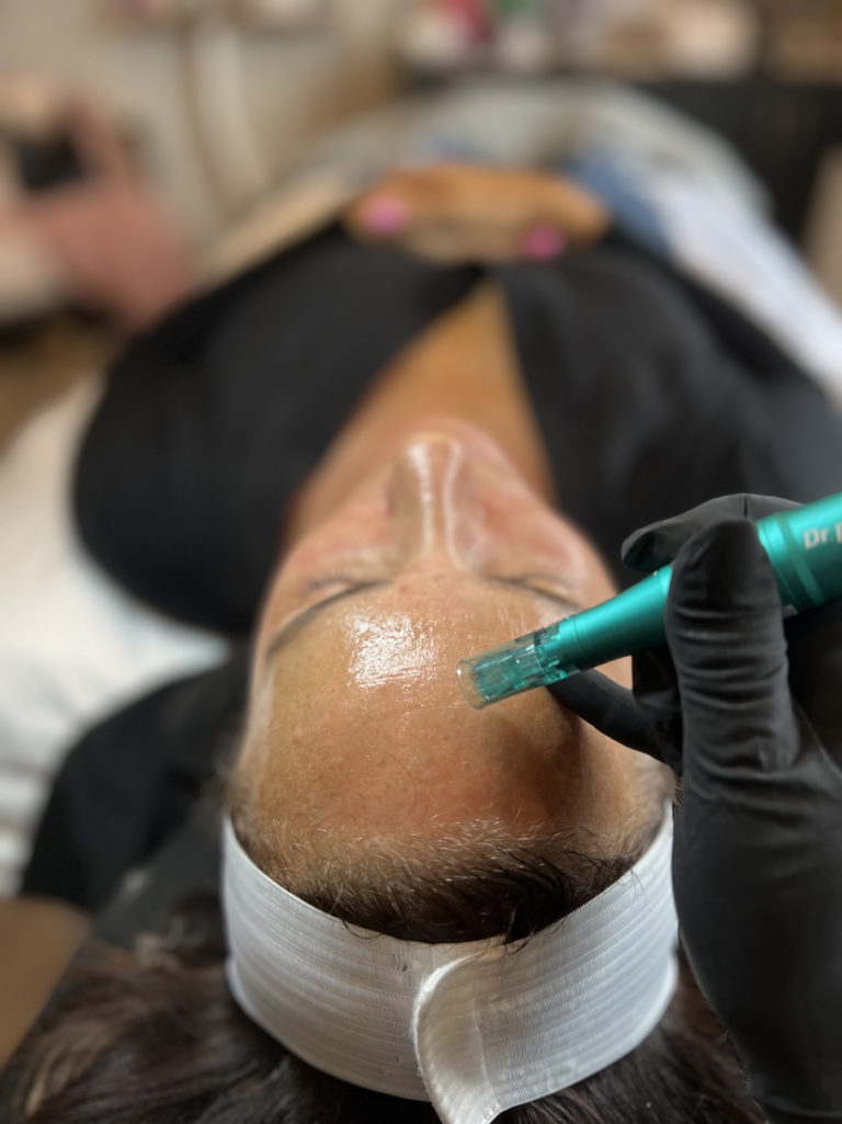 infinique-microneedling-3