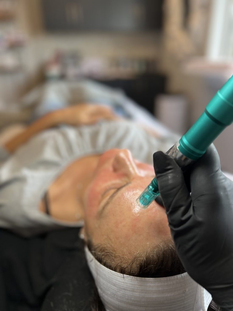 infinique-microneedling-8