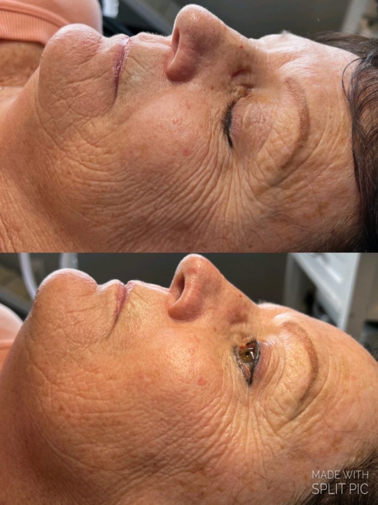 infinique-bio-Microneedling-1