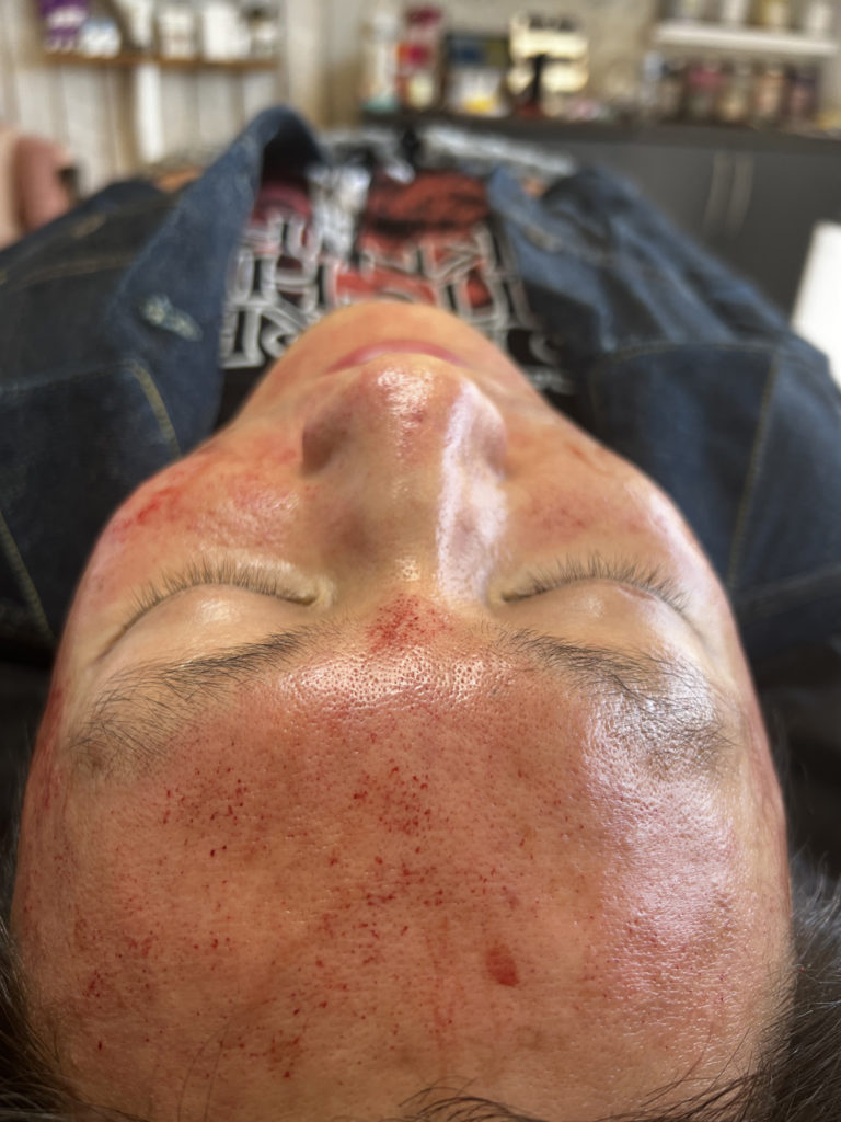 infinique-microneedling-13