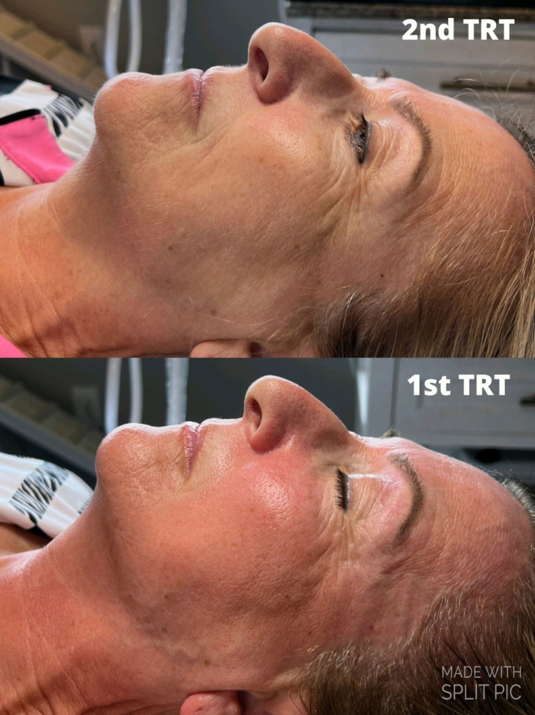 infinique-bio-microneedling-2
