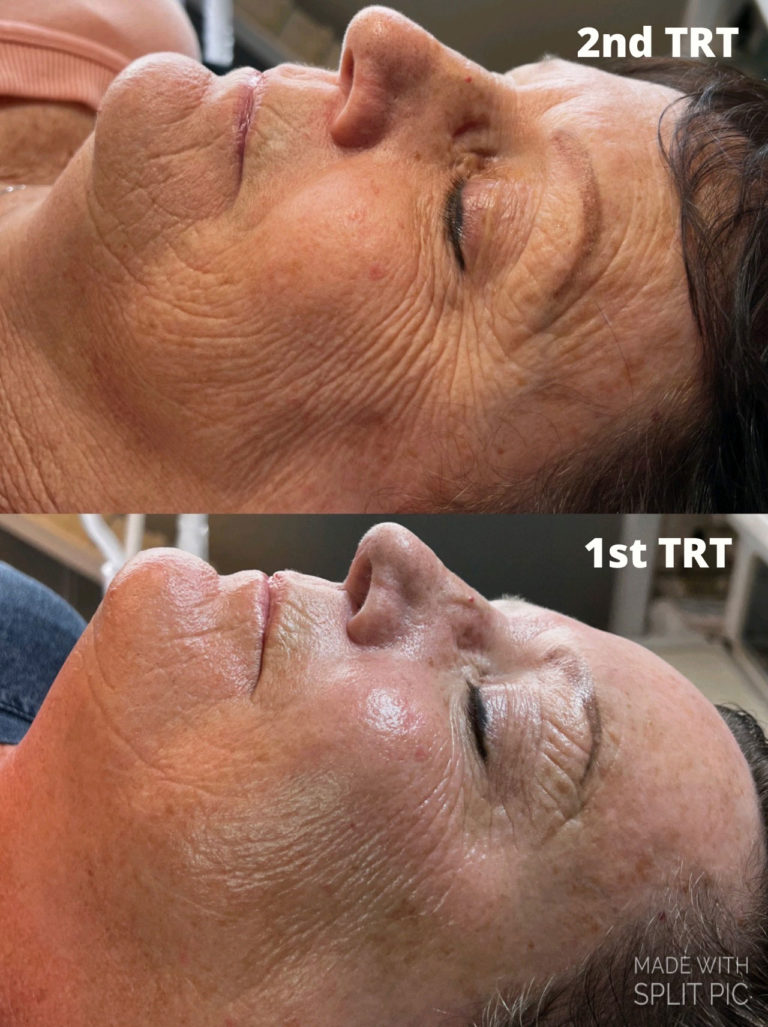 infinique-bio-microneedling-3