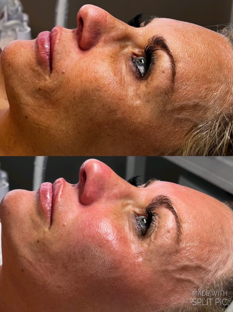 infinique-bio-microneedling-5