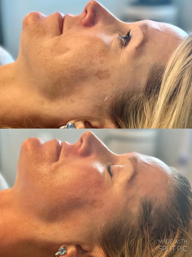 infinique-bio-microneedling-6