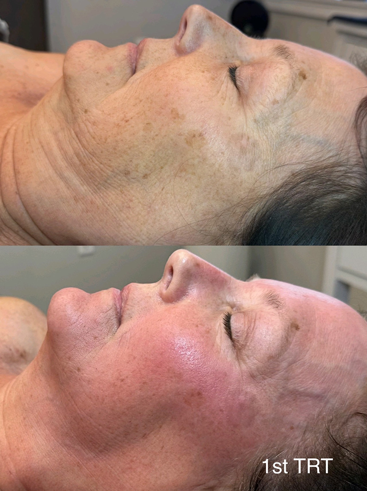 infinique-non-surgical-face-lift-1