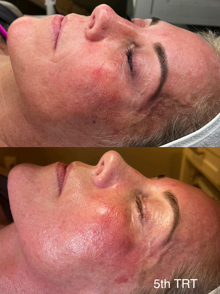 infinique-non-surgical-face-lift-2