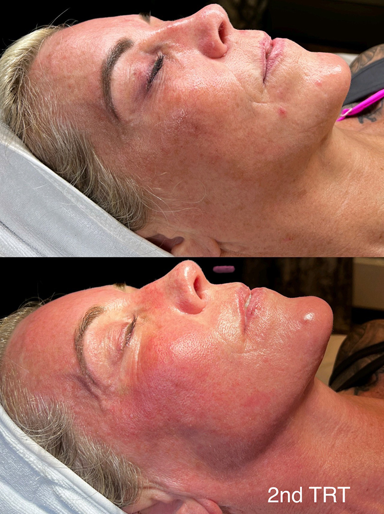 infinique-non-surgical-face-lift-5