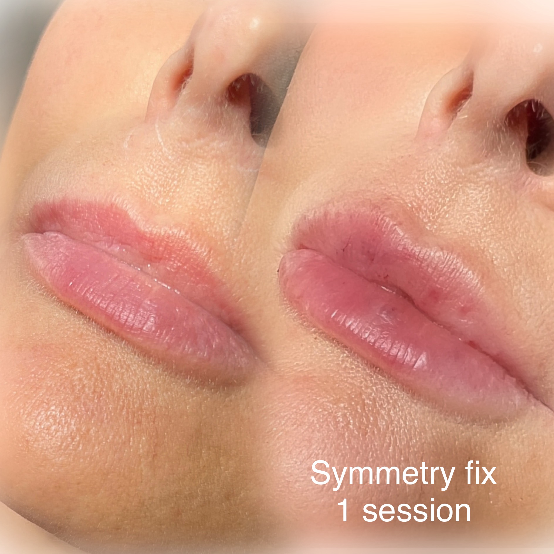 Needleless Lip Filler Infinique Skin & Spa