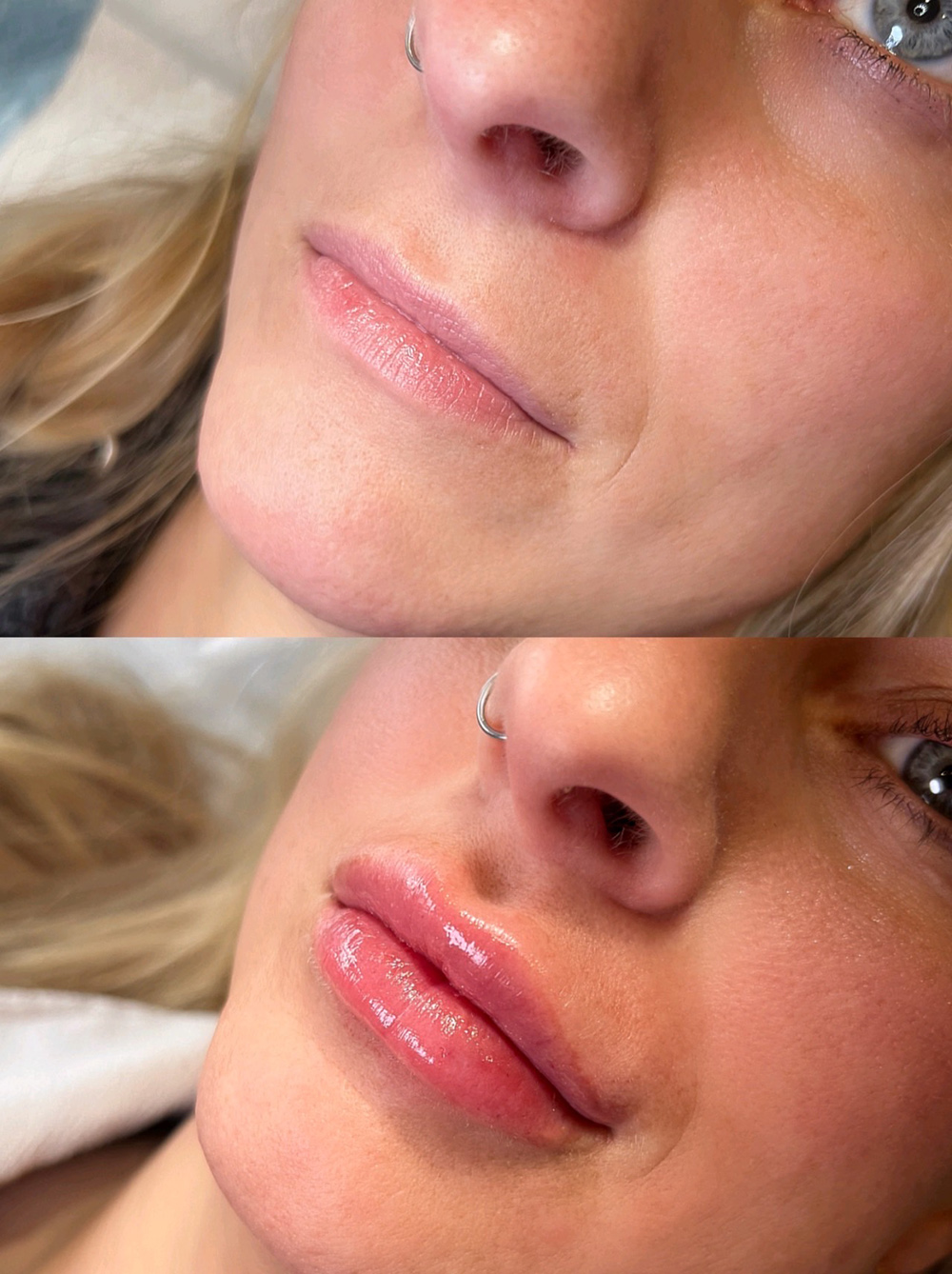 Needleless Lip Filler Infinique Skin & Spa