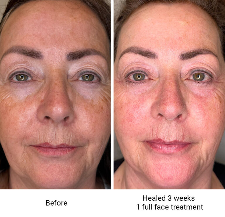 infinique-fibroblast-2026-4
