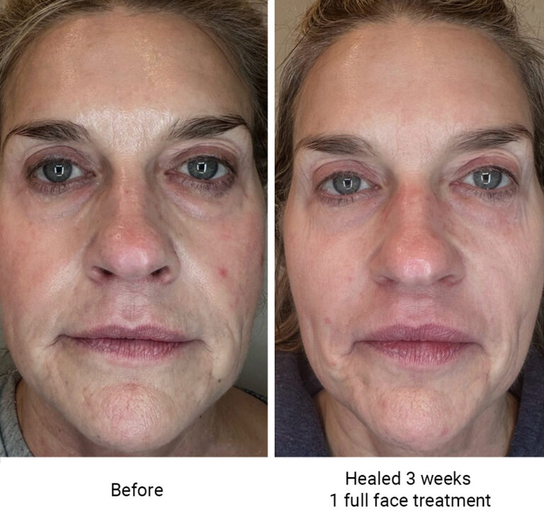infinique-fibroblast-2026-5