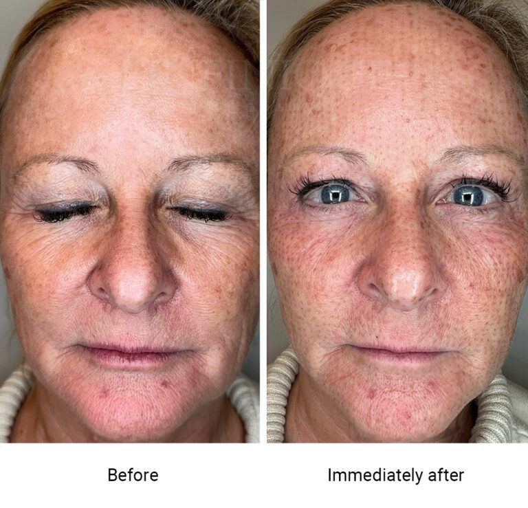 infinique-fibroblast-2026-6