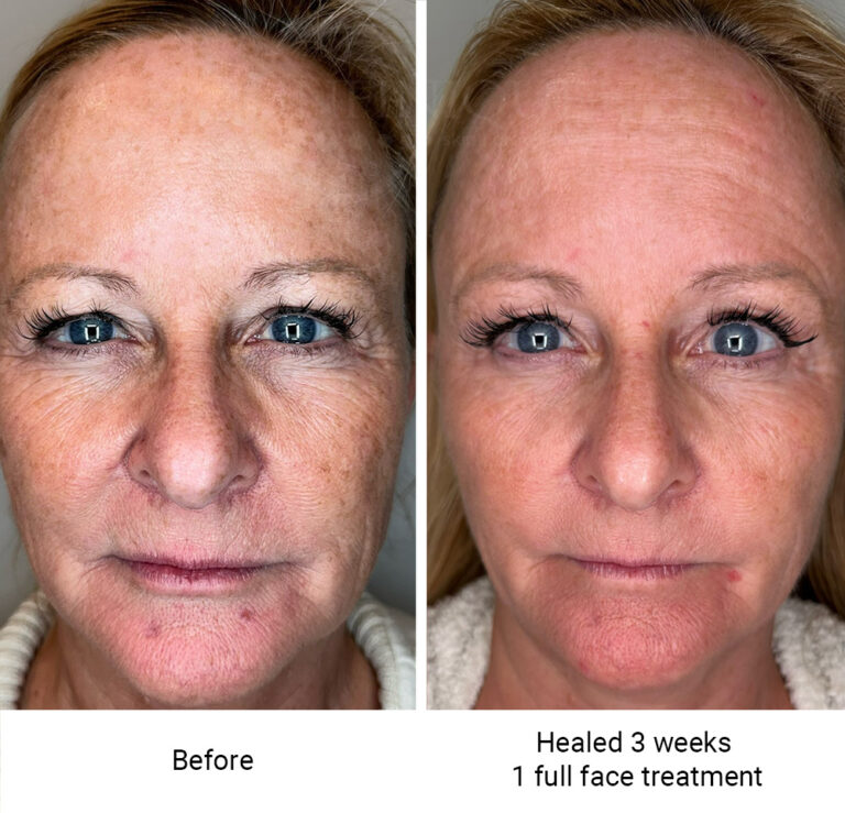 infinique-fibroblast-2026-7