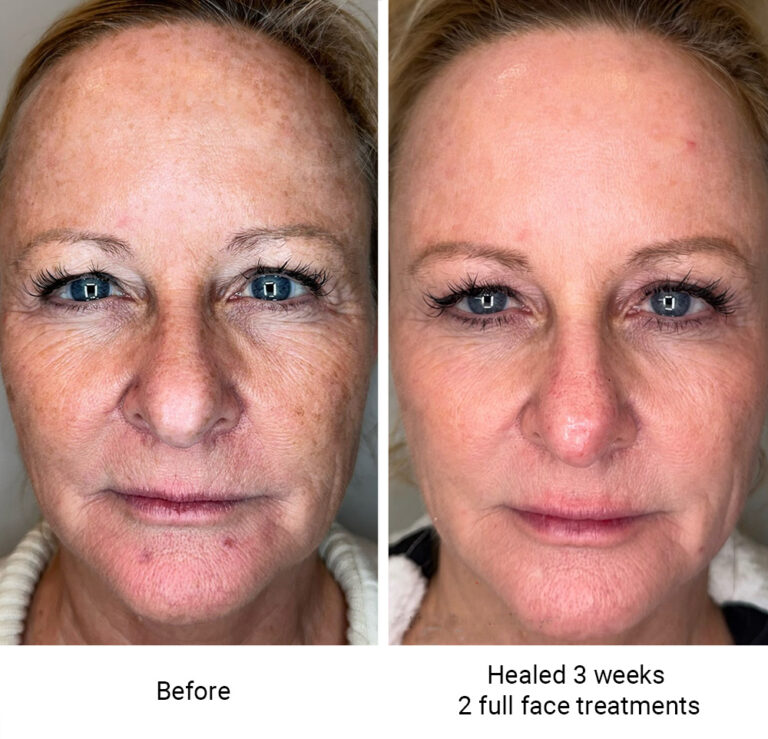 infinique-fibroblast-2026-8