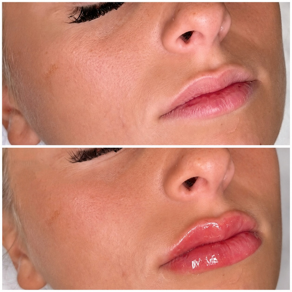 infinique-lip-filler-26-1