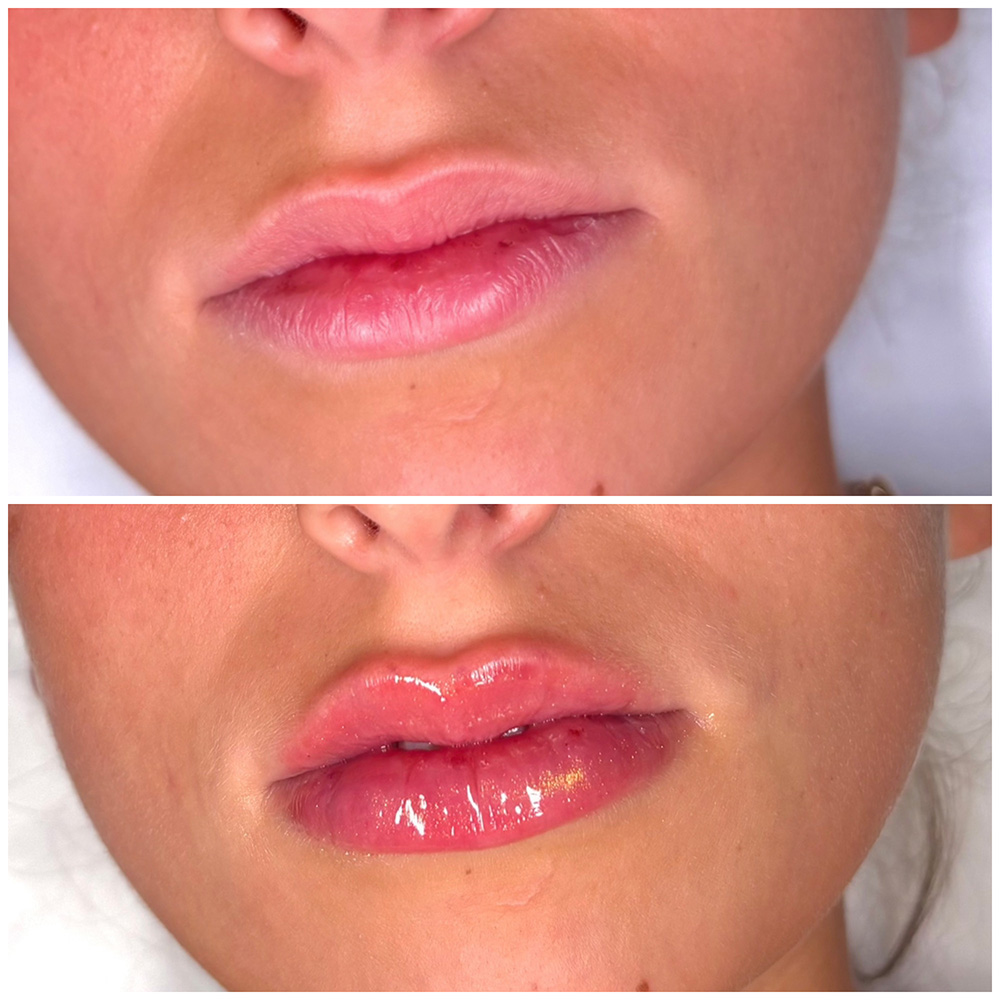 infinique-lip-filler-26-2