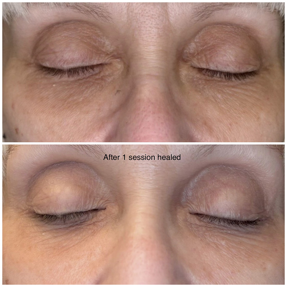 infinique-under-eye-5