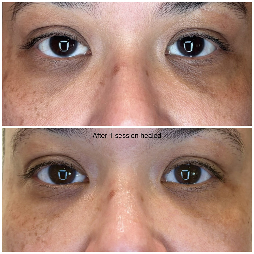 infinique-under-eye-6