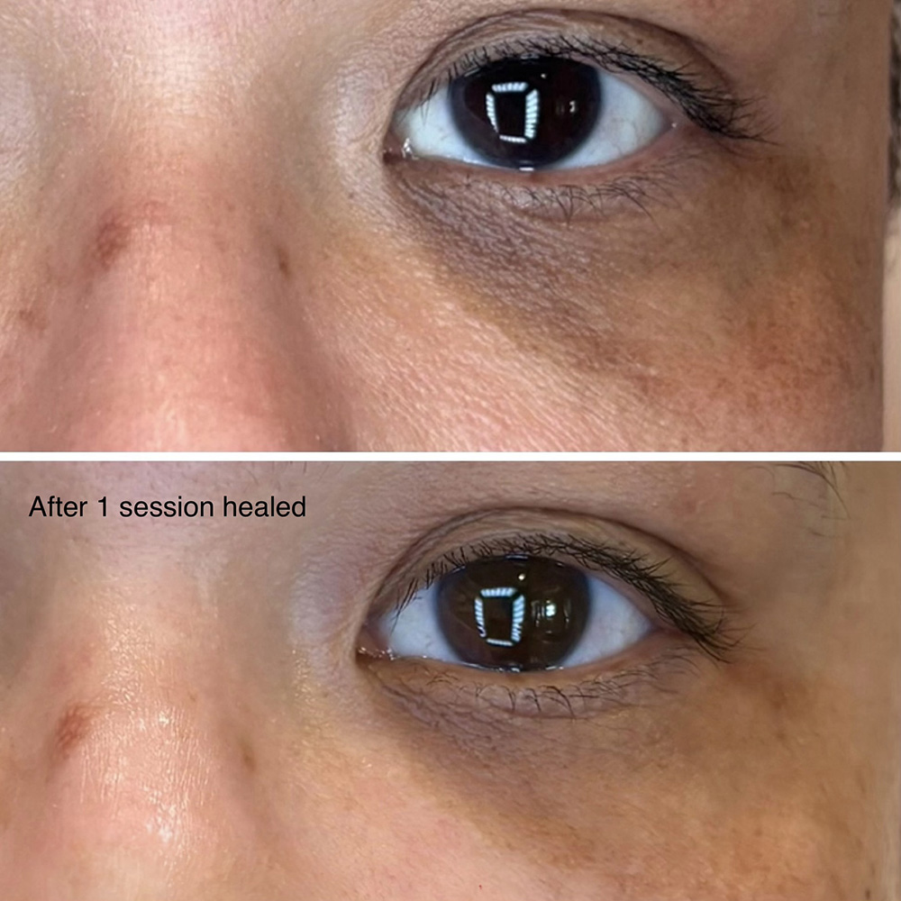 infinique-under-eye-7